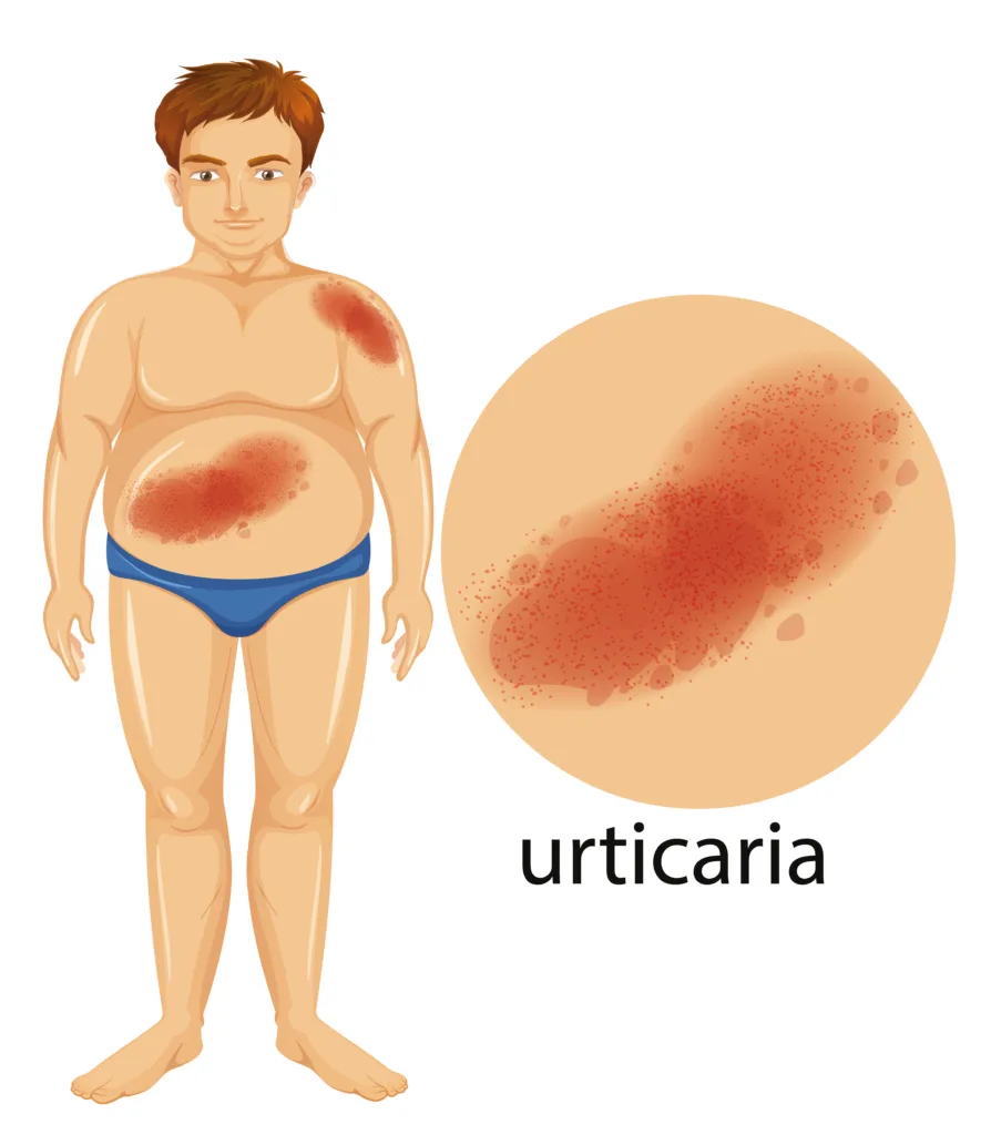 Cholinergic Urticaria