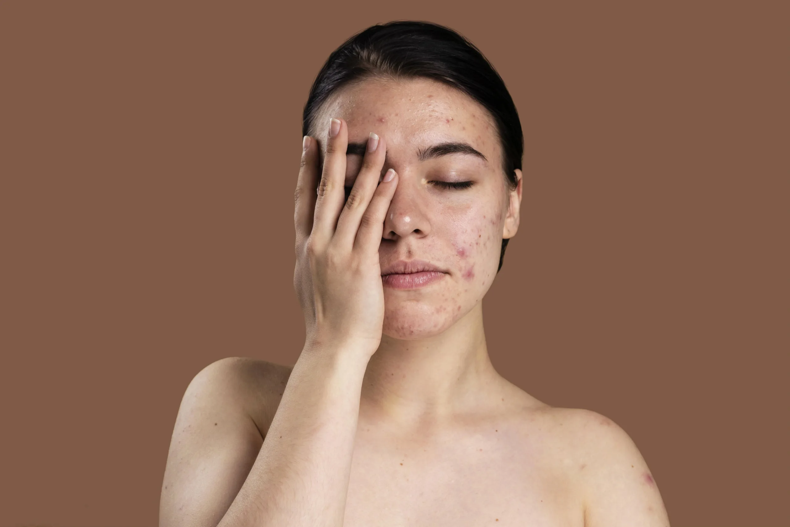 Understanding About Acne and Acne Scars